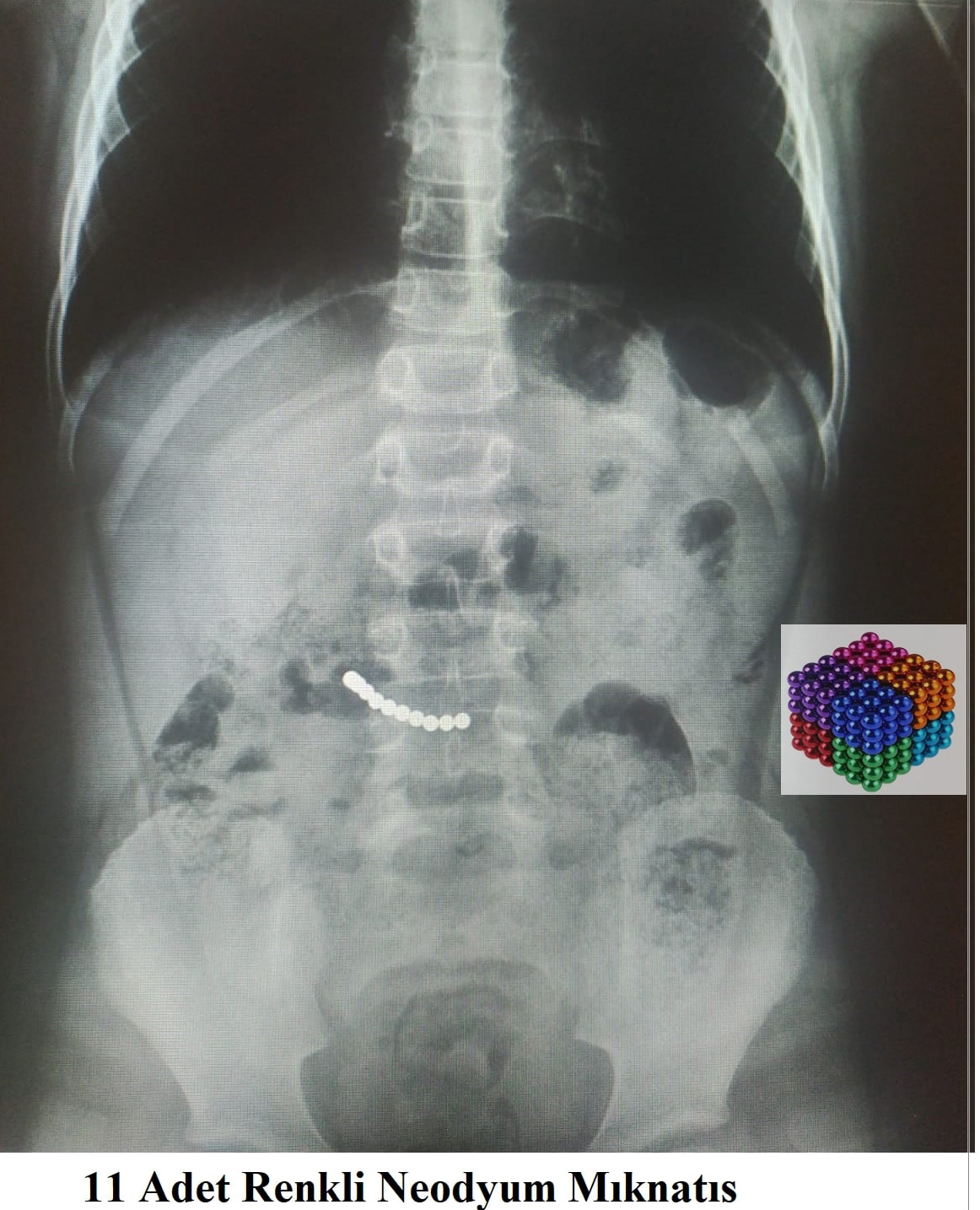 7 yaşındaki çocuğun midesinden 11 mıknatıs çıktı