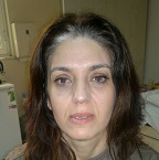 Yücelen’de göz çevresi kırışıklarına son